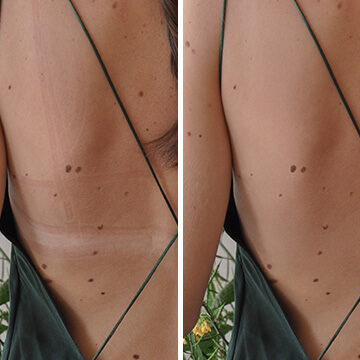 Remove Skin Marks After